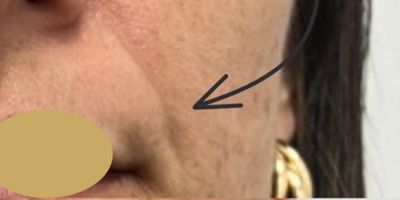 antes rej facial (1)
