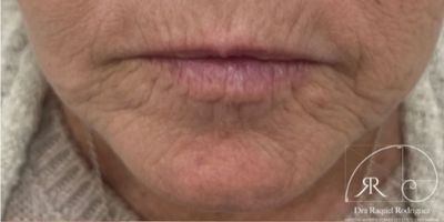 antes rej facial (2)