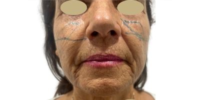 antes rej facial