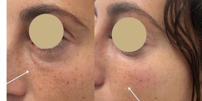 despues Eliminación Ojeras Las Palmas