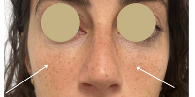 despues Eliminación Ojeras Las Palmas
