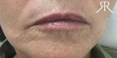 despues rej facial (3)