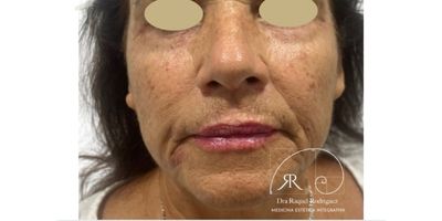 despues rej facial